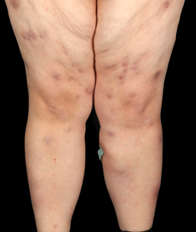 Skin lesions on both legs