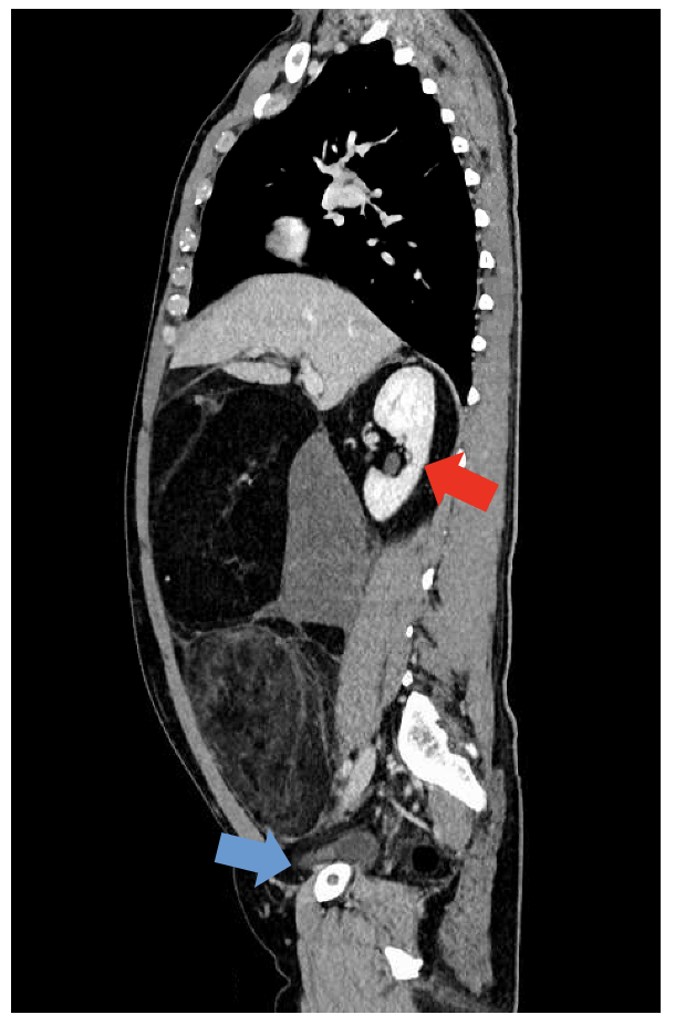 CT eines dedifferenzierten Liposarkoms, retroperitoneal rechts. Das Sarkom umauert den Ureter semi-zirkumferenziell bis zur Harnblase (blauer Pfeil), sodass ein Organerhalt onkologisch nicht möglich ist. Die rechte Niere (roter Pfeil) zeigt keinen Hinweis auf eine Tumorinfiltration, weshalb eine Autotransplantation erfolgte. 