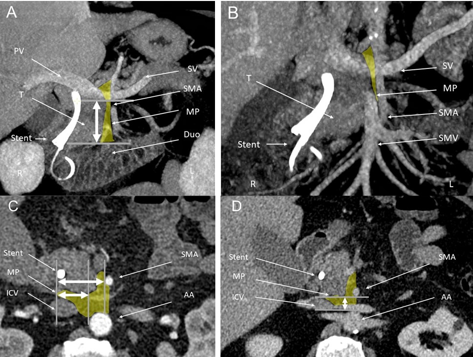 Auswertug der CT Bilder : Zusehen ist das gelb markierte Mesopankreas und die eingezeichneten geometrischen Dimensionen