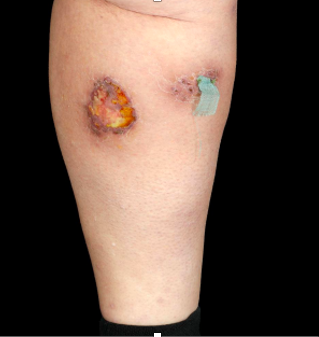 Skin lesions on lower leg