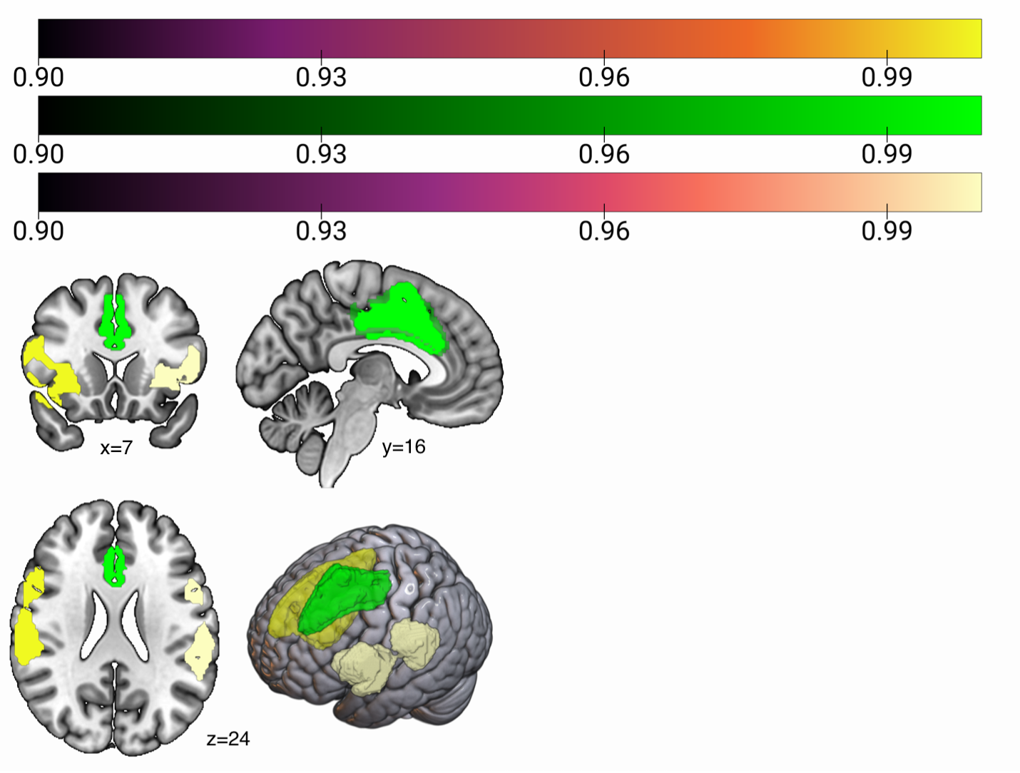 Figure 1. Conjunction Analysis: Shared Neural Activation for Empathy and Interoception. The analysis revealed three significant clusters of overlapping activation between empathy and interoceptive processing. These include the Right fronto-insular tract 5 (yellow), with 7,875 voxels, centered at MNI coordinates [32, -12, 0]; the Right supplementary motor area (SMA), Brodmann Area 6 (green), involving 3,814 voxels, with a peak at [4, 8, 50]; the Left anterior insula, Brodmann Area 47 (ivory), with 5,529 voxels at [-32, 16, -2]. The probability was set to 0.00250, peak height at 0.00025, extent thresholds at 10, and tolerable p-values at 0.1.