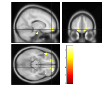 Whole-brain VBM analysis revealed significantly greater gray matter volume in the right medial orbital gyrus in the living-alone group compared with the family-living group (p = 0.043, FWE-corrected).