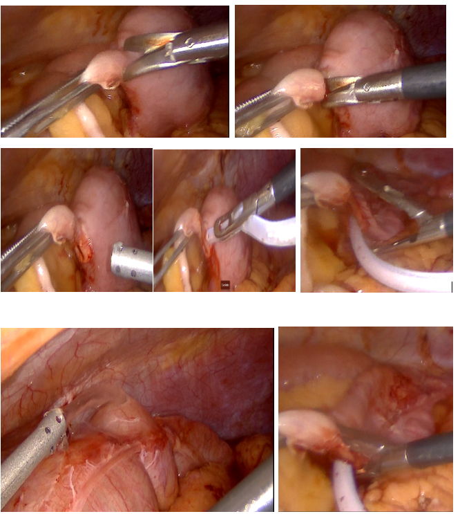 1.	Appendiceal Access: A small laparoscopic incision is made at the base of the appendix. A Robinson drain is inserted through this opening, serving as a conduit for controlled CO₂ insufflation. 2.	Saline Infusion: The peritoneal cavity is filled with sterile saline to create a medium for visualizing escaping gas. 3.	Insufflation and Observation: Laparoscopic CO₂ is insufflated through the Robinson drain. Gentle external or laparoscopic palpation of the colon is performed to assess for air leaks. The appearance of air bubbles in the saline indicates a perforation site.