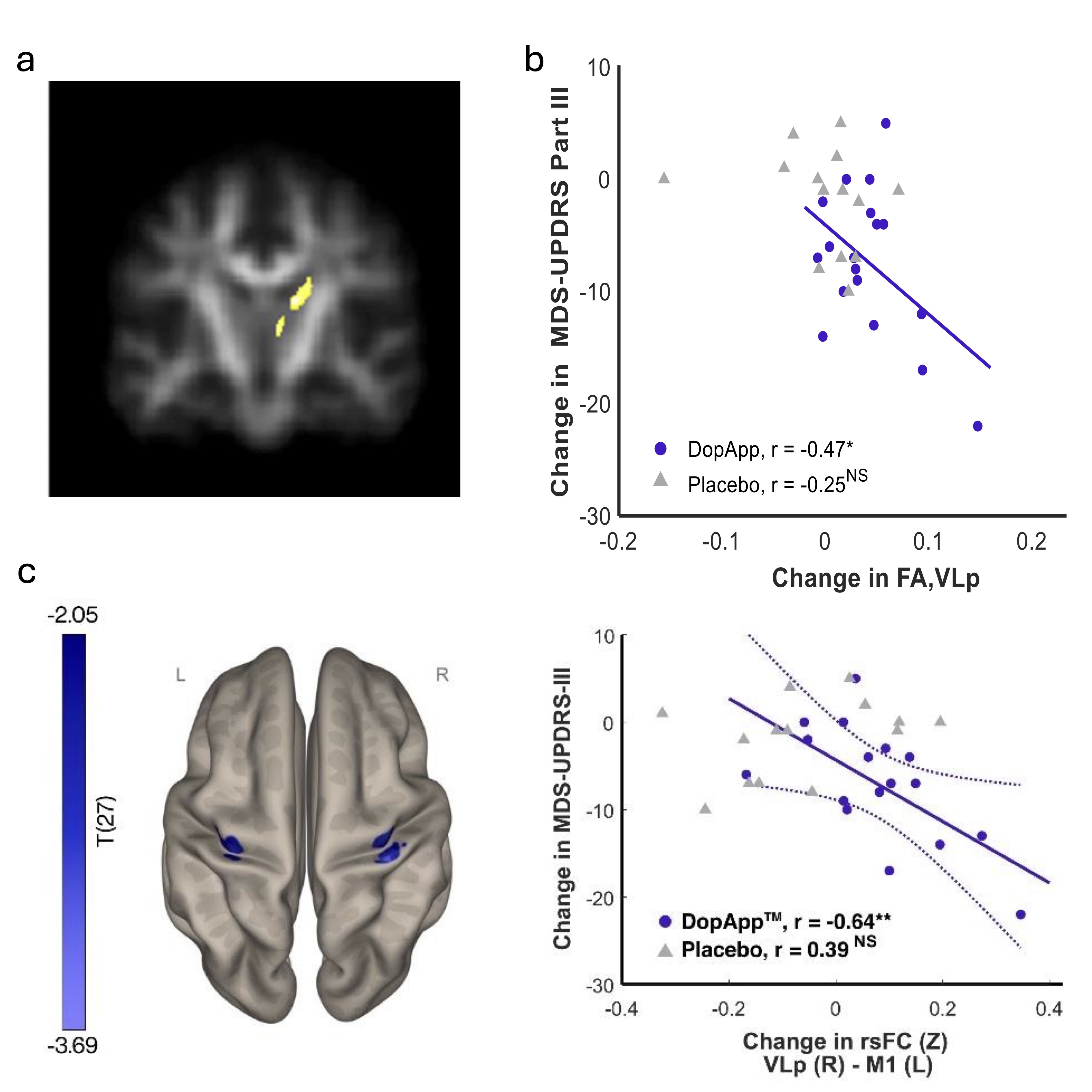 Figure showing structural and functional brain changes associated with motor improvement. (a) Brain slice highlighting a cluster of increased fractional anisotropy in the right thalamic region following DopApp™ intervention compared with placebo. (b) Scatter plot showing that greater increases in fractional anisotropy in the right ventral lateral posterior thalamus are associated with greater improvement in motor symptoms (lower MDS-UPDRS Part III scores) in the DopApp™ group, but not in placebo. (c) Brain surface map and scatter plot showing that increased functional connectivity between the right ventral lateral posterior thalamus and left primary motor cortex correlates with motor improvement in the intervention group only.