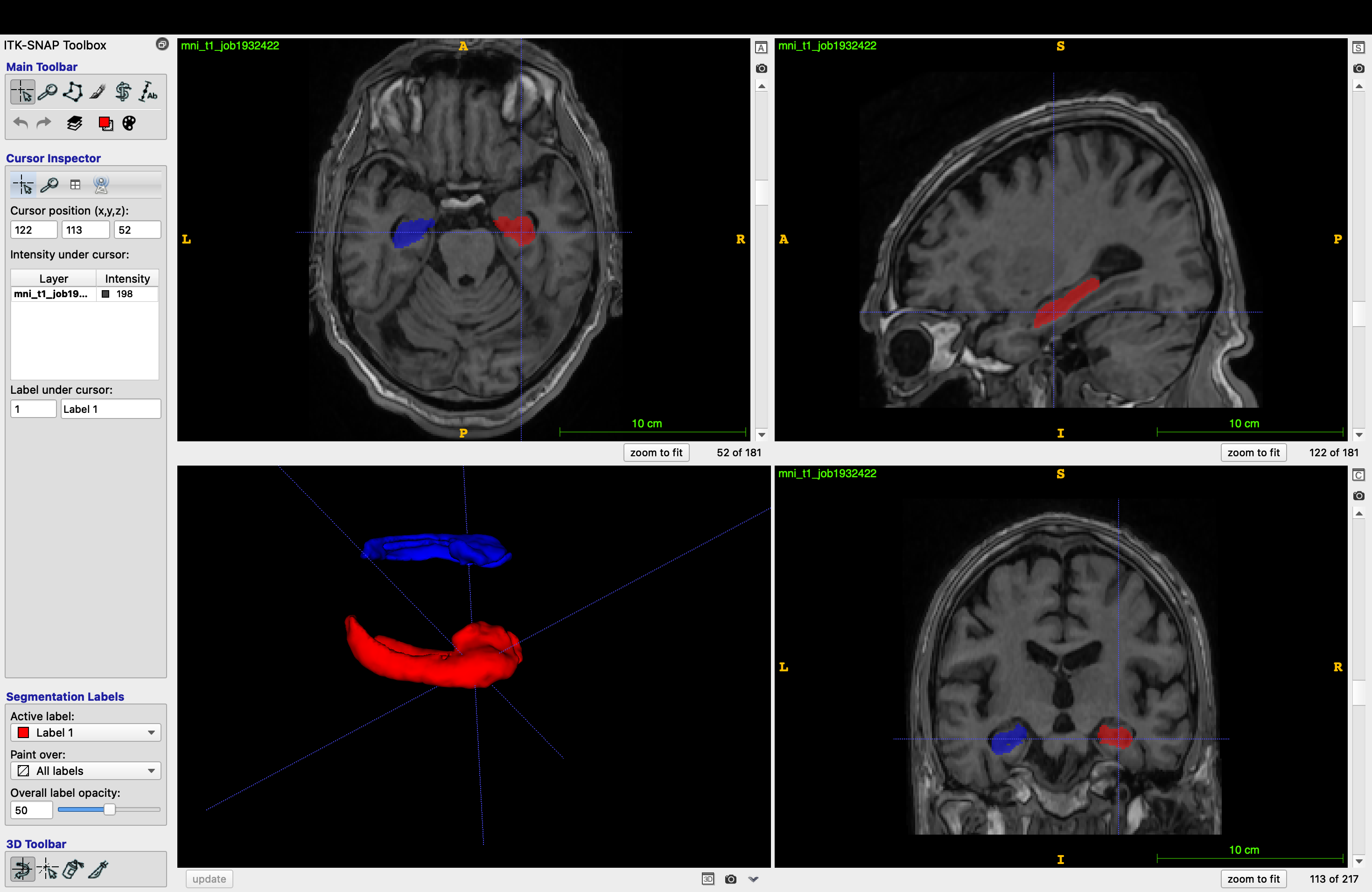Two and three-dimensional images showing anatomical accuracy and spatial location obtained after hippocampal segmentation in ITK SNAP.