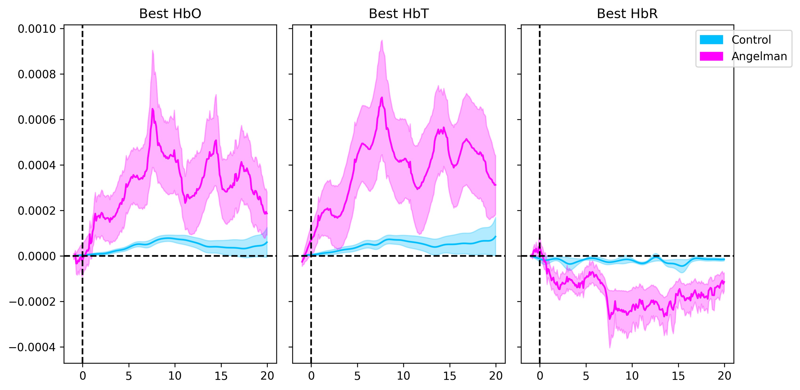 Average fNIRS signal across channels for baseline and stimulation conditions in neurotypical controls and individuals with AS. The neurotypical control group (top row, N = 17) and the group of individuals with AS (bottom row, N = 23) are shown across measures of oxygenated hemoglobin (HbO), total hemoglobin (HbT), and deoxygenated hemoglobin (HbR). The baseline condition is depicted in blue, while the stimulation condition is shown in red. In the control group, visual stimulation produced a positive deflection in HbO and HbT concentrations compared to baseline, with minimal change in HbR— reflecting a canonical pattern of neural activation in the visual cortex. Notably, despite the challenges typically associated with eliciting reliable cortical responses in individuals with neurodevelopmental disorders, participants with AS also exhibited increases in HbO and HbT during stimulation, although with greater inter-subject variability. These results highlight the robustness and clinical relevance of the paradigm, demonstrating its capacity to evoke measurable cortical responses even in populations with severe neurological impairments. 