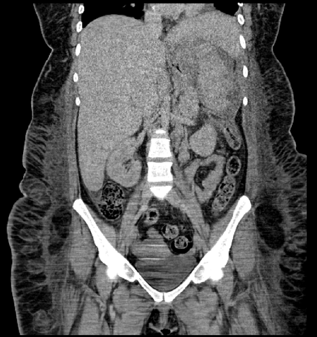 Computer tomography showing hepatosplenomegaly