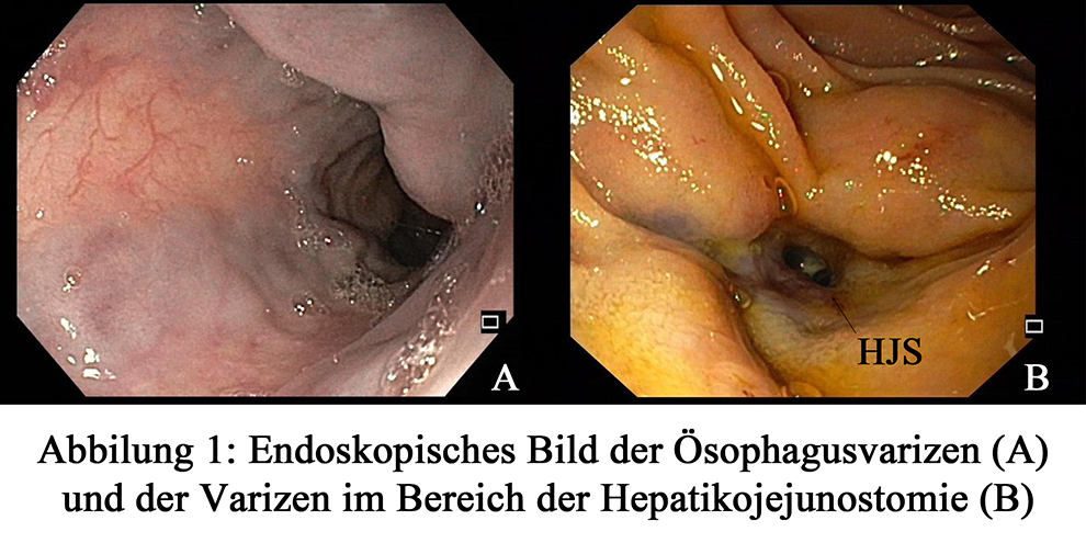 Abbilung 1: Endoskopisches Bild der Ösophagusvarizen (A) und der Varizen im Bereich der Hepatikojejunostomie (B)