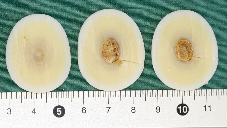 Schnittbild des Fremdkörpers