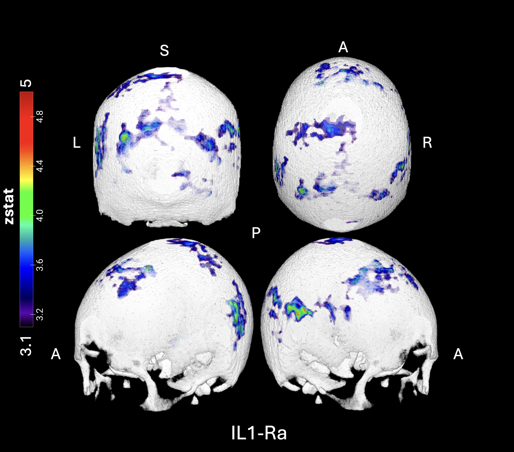 3D mapping of the voxels where patients with chronic pain showed a voxel-wise positive correlation between skull bone marrow [11C]PBR28 TSPO signal and IL1-Ra fold change (LPS-stimulated / baseline) overlaid onto a 3D skull model in the standard MNI152 space in 21 patients, corrected for Genotype, Sex, Age, Weight and Baseline
