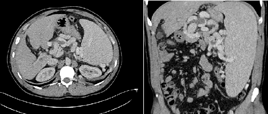 Zwei CT Bilder von Patient 1, 1. transversaler Schnitt, 3,2cm großes Aneurysma des Truncus ersichtlich. Bild2: Coronarer Schnitt CT mit massiver Splenomegalie und deutlich ersichtlichen Kollateralen.