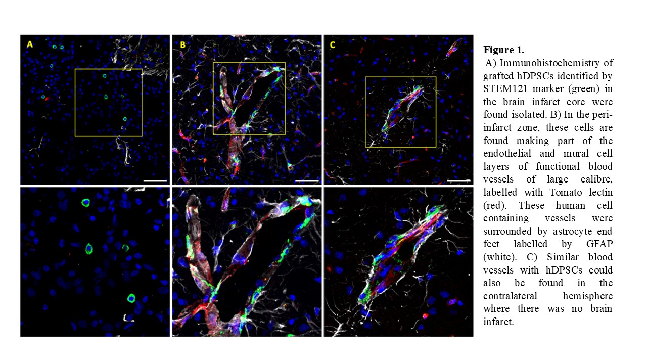  A) Immunohistochemistry of grafted hDPSCs identified by STEM121 marker (green) in the brain infarct core were found isolated. B) In the peri-infarct zone, these cells are found making part of the endothelial and mural cell layers of functional blood vessels of large calibre, labelled with Tomato lectin (red). These human cell containing vessels were surrounded by astrocyte end feet labelled by GFAP (white). C) Similar blood vessels with hDPSCs could also be found in the contralateral hemisphere where there was no brain infarct. 