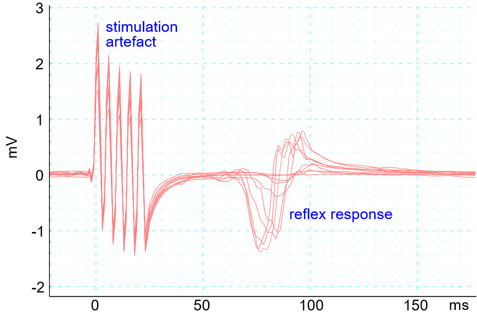 Nociceptive withdrawal reflex recordings from multiple trials. The waveform on the left is the electrical stimulation artefact. The reflex occurs around 70-100 milliseconds.