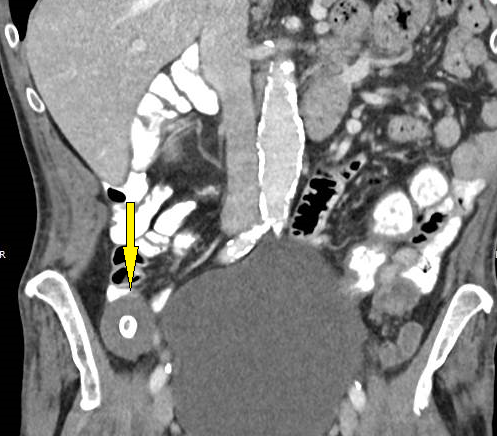 CT-morpholigische Darstellung der Raumforderung pararectal im Rahmen des Stagings