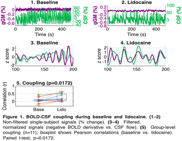A scientific multi-panel figure consisting of 3 rows. First row features two plots at the top showing raw time series: the left plot for Baseline and the right for Lidocaine, with purple gGM and green CSF signals showing fluctuations. Directly below these, two more plots show the 'Negative derivative' of these signals; lidocaine waves appear highly oscillatory and synchronized. The ‘last row graph, Group coupling,’ contains boxplot with individual subject lines connecting Baseline to Lidocaine states. The plot 'Coupling,' shows a clear overall coupling with lidocaine. 