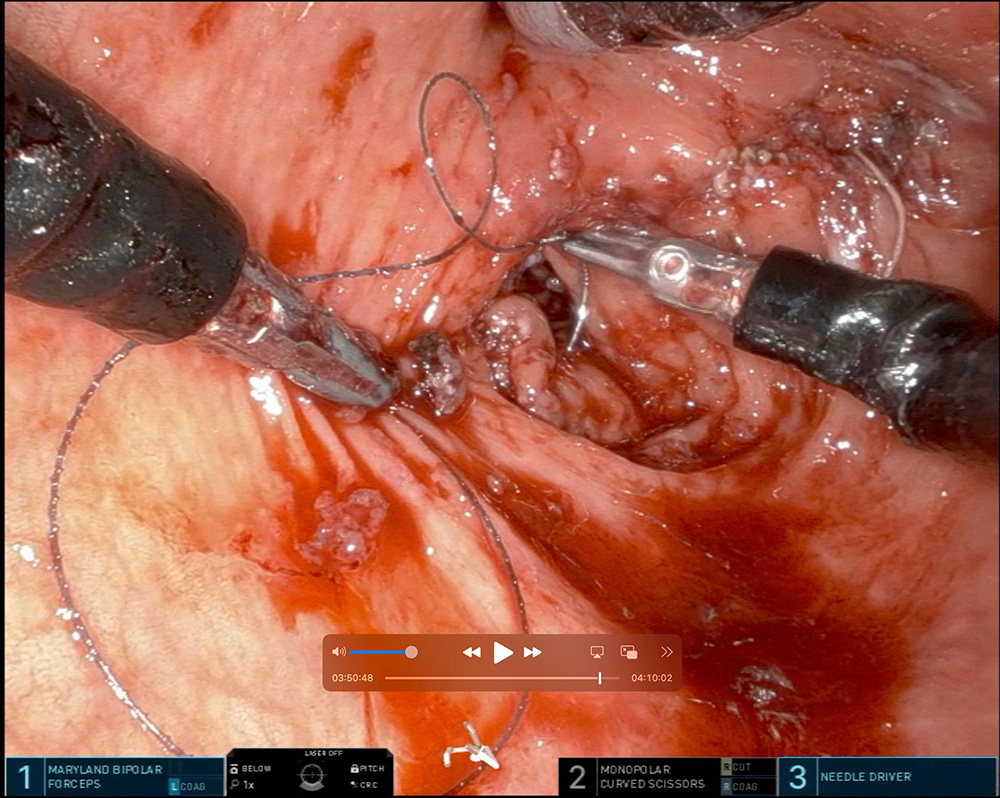 Intraluminale Naht mit da Vinci SP