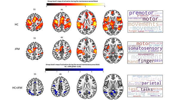 Whole-brain fMRI activation maps highlighting reduced parietal, premotor, and prefrontal engagement during sustained force maintenance in adolescents with juvenile fibromyalgia relative to healthy controls.