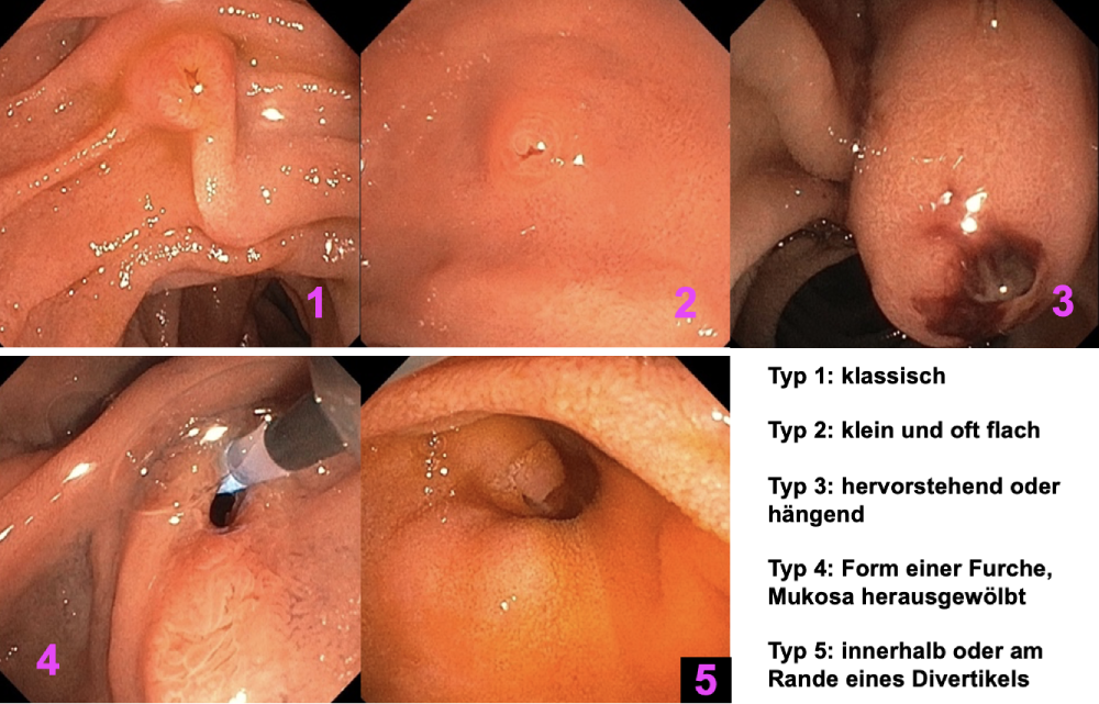 Typ 1: klassisch, Typ 2: klein und oft flach, Typ 3: hervorstehend oder hängend, Typ 4: Form einer Furche, Mukosa herausgewölbt, Typ 5: innerhalb oder am Rande eines Divertikels