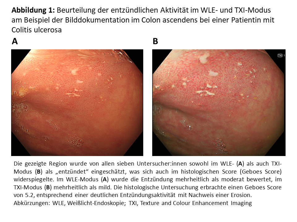 Abbildung 1: Beurteilung der entzündlichen Aktivität im WLE- und TXI-Modus am Beispiel der Bilddokumentation im Colon ascendens bei einer Patientin mit Colitis ulcerosa