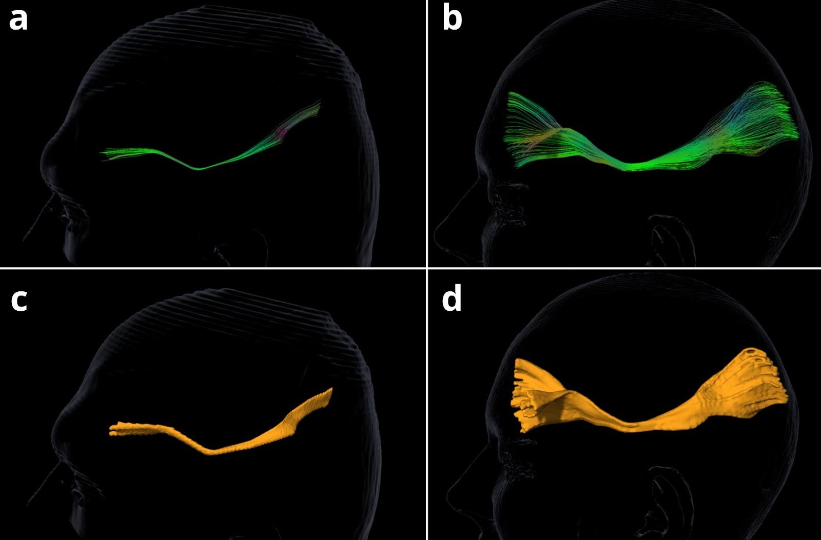 Figure 1. Visual comparison of SFOF in PD patient (a, c) and healthy control (b, d).