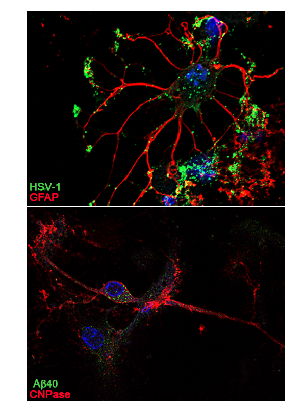 Figure 1. Representative immunofluorescence of a mature astrocyte and oligodendrocyte. A) Astrocyte expressing GFAP (typical astrocytic protein; in red) infected by HSV-1 (in green). B) Previously infected oligodendrocyte expressing CNPase (oligodendrocyte protein; in red) and intracellular AB accumulation (AB40; in green). The nuclei in both cases are marked with DAPI (in blue). 