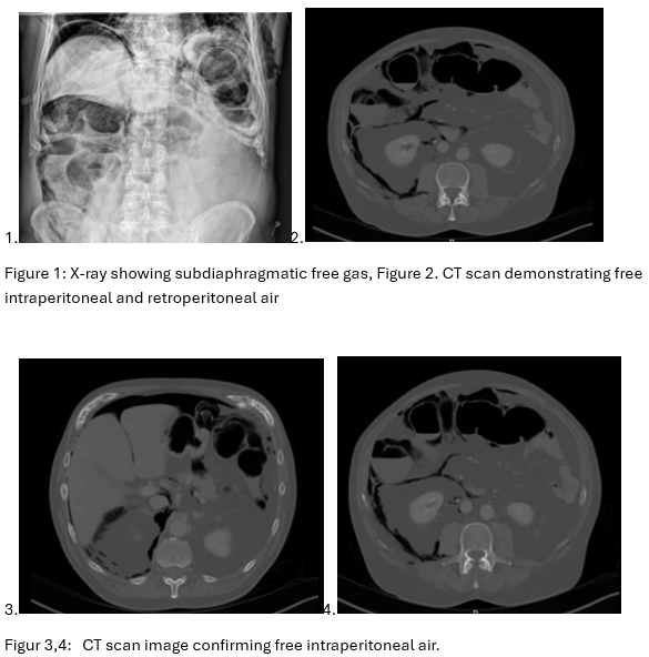 Plain abdominal radiographs demonstrated free subdiaphragmatic gas and significant colonic distension (Figure 1). Subsequent CT imaging confirmed pneumoperitoneum, mediastinal emphysema, and retroperitoneal free air, suggesting a perforation of the right colon (Figures 2–4).