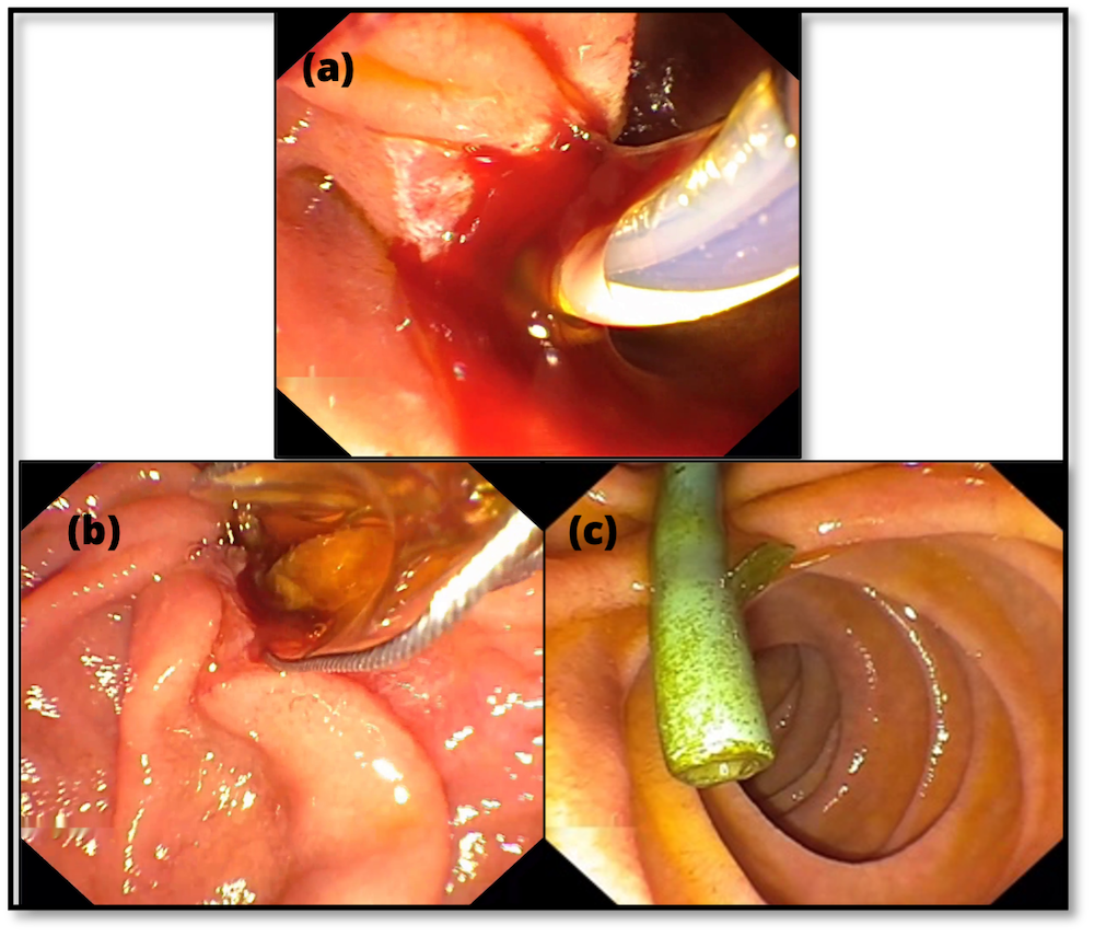 Abbildung 1. Beispielbilder aus der technischen Validierung des Datensatzes: (a) signifikante Blutung, (b) Ausfluss aus der Papilla Vateri, (c) Stent einliegend zu Untersuchungsbeginn.