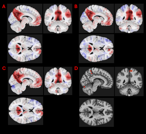 Figure 1 shows 4 panels. Each panel contains the sagittal, coronal and axial planes of a standard space brain with results superimposed. The first, panel A, shows default mode network connectivity of all subjects. Panel B shows the default mode network connectivity in heading group subjects immediately after heading protocol. Panel C shows the default mode network connectivity in virtual reality group subjects immediately after heading. Panel D shows the significant changes in default mode connectivity immediately after heading between the heading and VR groups (panel b and c).