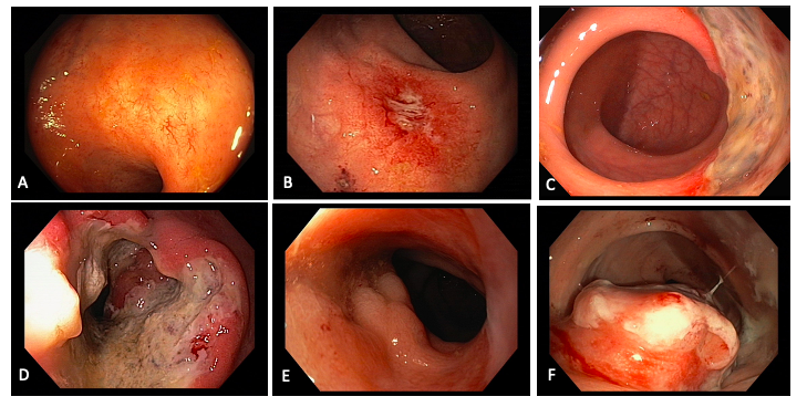 Endoscopic features at response assessment. (A), Flat scar, (B) small flat ulcer <1cm, (C) large ulcer, (D) ulcer with an irregular border, (E) adenomatous mass, (F) tumorous mass.