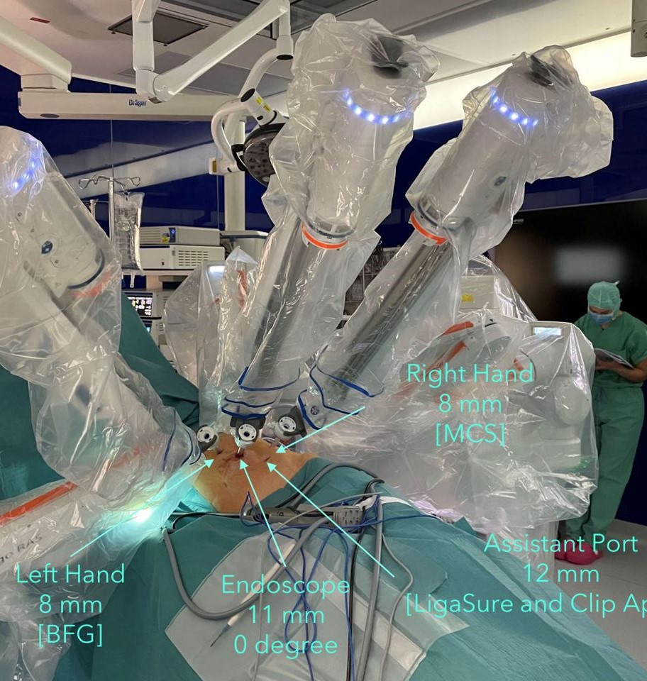 Trokarpositionen linker Oberbauch Hugo