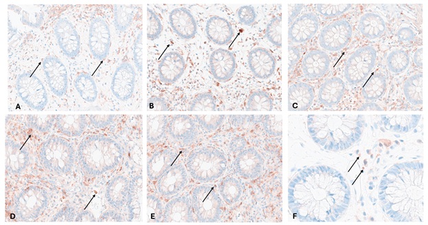 Immunhistochemische Färbungen der Biopsien A: Colon asc. Remission; B: Colon asc. Mayo Score 1-2; C: Sigma Mayo Score 2; D: Colon transv. Mayo Score 3; E: Sigma Mayo Score 3; F: Colon desc. Kontrolle Pfeile: IRF5+ Zellen
