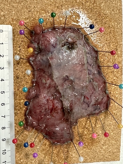 Endoskopisch intermuskuläre Dissektion (EID) Praeparat