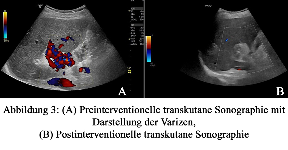 Abbildung 3: (A) Preinterventionelle transkutane Sonographie mit Darstellung der Varizen, (B) Postinterventionelle transkutane Sonographie