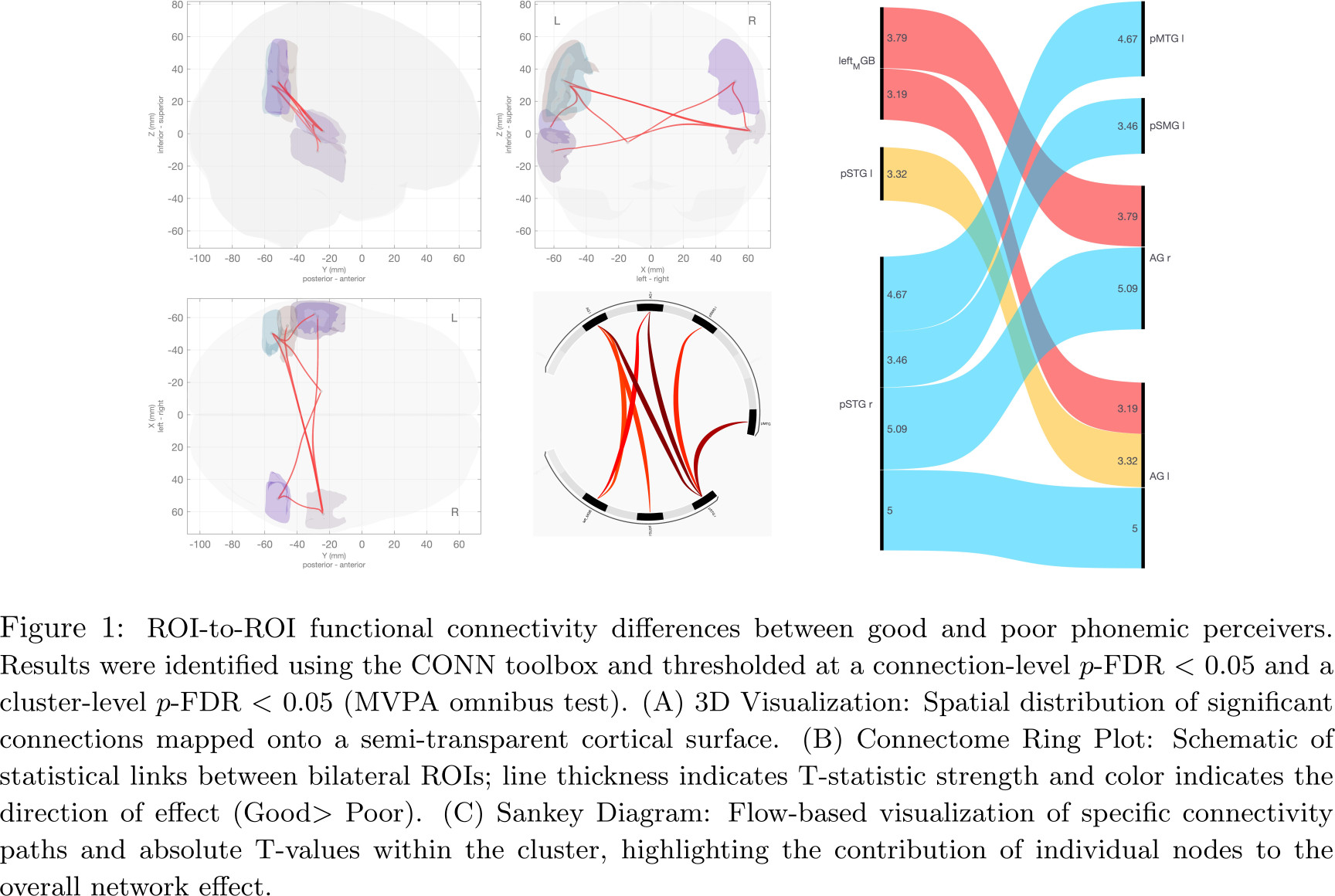 ROI-to-ROI functional connectivity differences between good and poor phonemic perceivers. Results were identified using the CONN toolbox and thresholded at a connection-level $p$-FDR $<$ 0.05 and a cluster-level $p$-FDR $<$ 0.05 (MVPA omnibus test). (A) 3D Visualization: Spatial distribution of significant connections mapped onto a semi-transparent cortical surface. (B) Connectome Ring Plot: Schematic of statistical links between bilateral ROIs; line thickness indicates T-statistic strength and color indicates the direction of effect (Good$ >$ Poor). (C) Sankey Diagram: Flow-based visualization of specific connectivity paths and absolute T-values within the cluster, highlighting the contribution of individual nodes to the overall network effect.