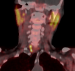 Cholin-PET-CT bei Mehrdrüsenerkrankung