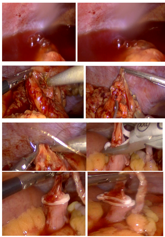 Positive bubble test demonstrating air leakage during insufflation, then after Confirmation of a perforation at the hepatic flexure Primary repair of the colonic defect and proceed withe the appendectomy and Closure of the appendiceal access using laparoscopic clips
