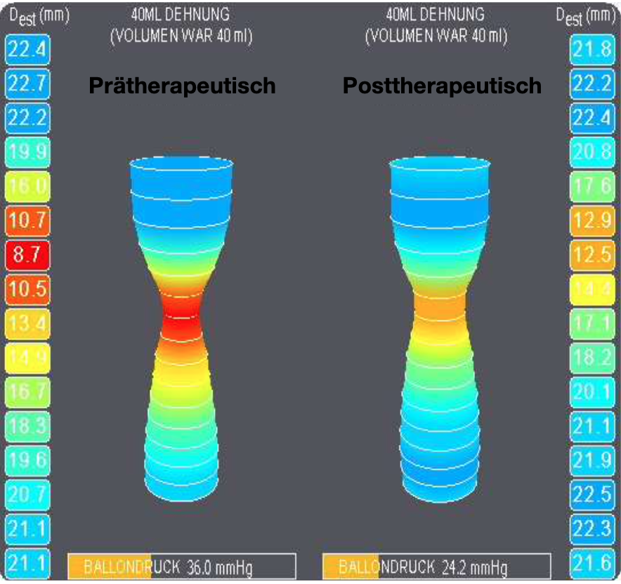 Zwei farbkodierte 3D-Impedanzplanimetrie-Darstellungen (EndoFLIP) einer Ösophagusstenose bei 40 ml Füllvolumen: links „Prätherapeutisch“ mit starker Mitteneinschnürung, rechts „Posttherapeutisch“ mit abgeschwächter Einschnürung.