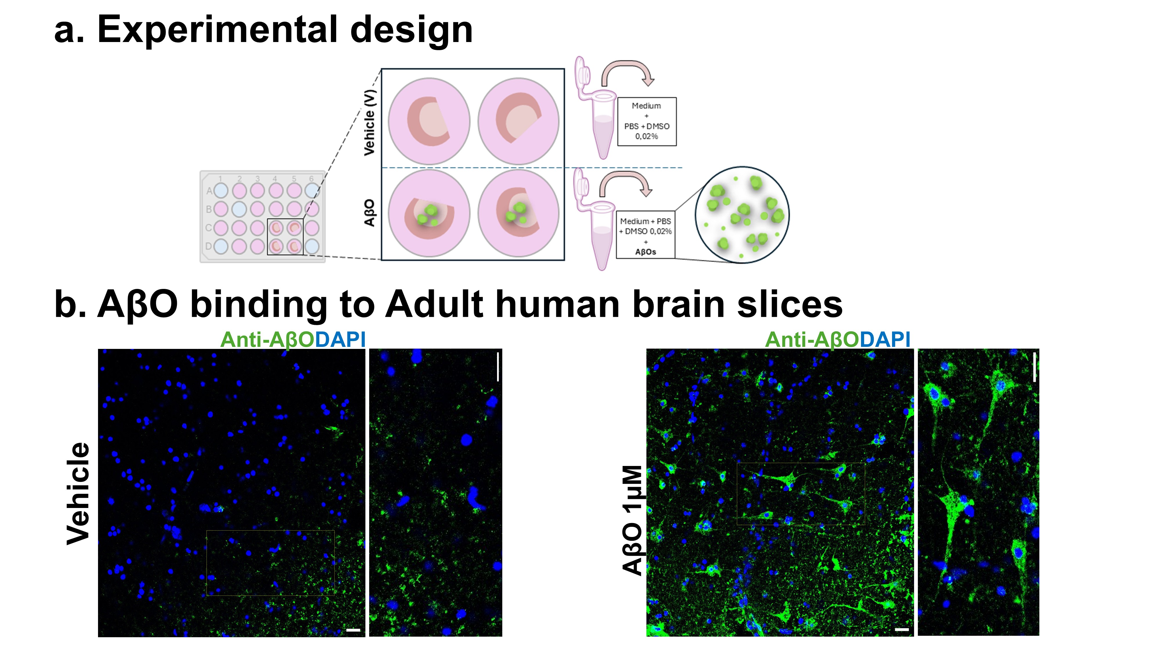 Upper region: Diagram/Scheme of experimental design Human brain slice cultures scheme, showing one slice per well (grey and white matters kept) and the experimental conditions (vehicle as control and AbetaO incubated slices). Tubes showing the content of each condition, with scheme of Abeta aggregates. Down region: Confocal image showing round blue structures as nucleus of cells and green speckled and cellular patterns as staining of AbetaO aggregates. Comparision between control (vehicle, left) and AbetaO treated (right), with higher intensity of green staining, with cellular-like structures on the right panel.Yellow box highlights digitally zoomed regions presented.