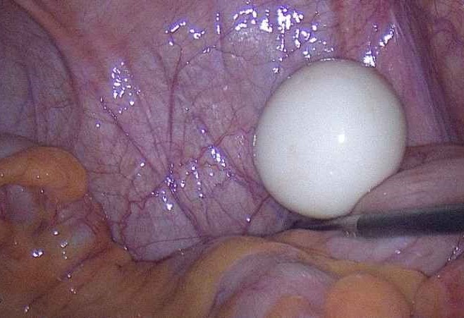 intraoperatives laparokospische Bild des Fremdkörpers