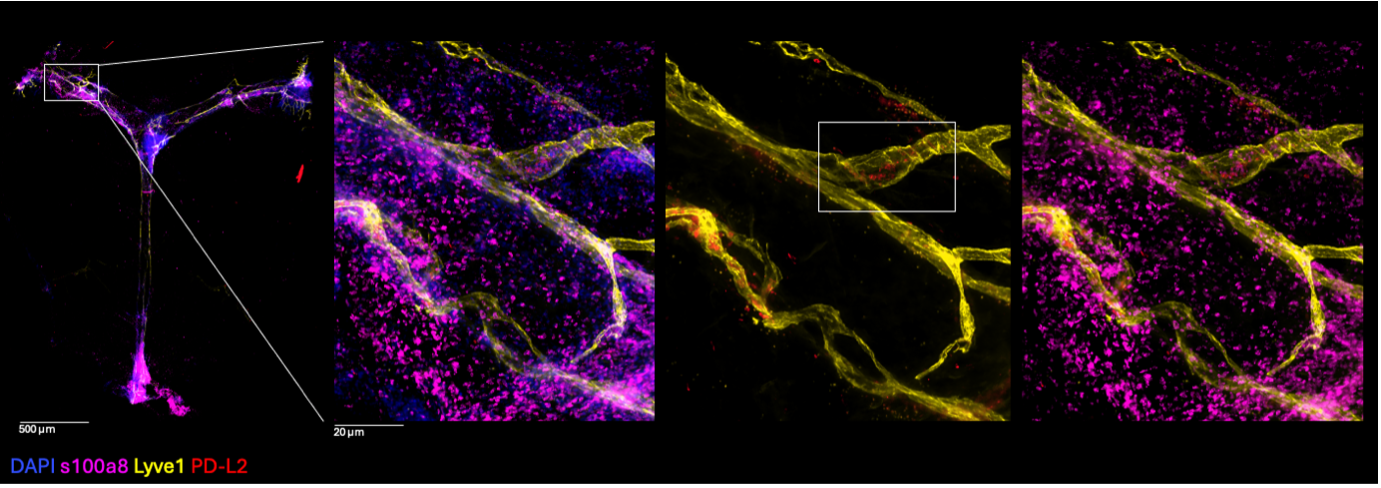 Figure 1. PD-L2+ cells within the MLVs under inflammatory conditions. Representative image showing a cluster of PD-L2+ cells located in the dural transverse sinus, circulating within the MLVs, stained with anti-Lyve1 antibody (Lymphatic vessel endothelial hyaluronan receptor 1, in yellow). Neutrophils are stained with anti-s100a8 antibody (s100 calcium-binding protein A8, in magenta).